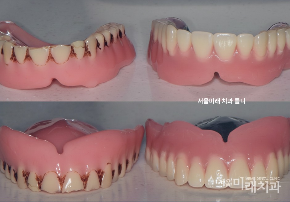 전체틀니 치료 전후 비교 사례