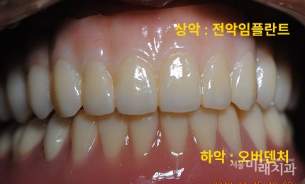 전악 임플란트 치료 후