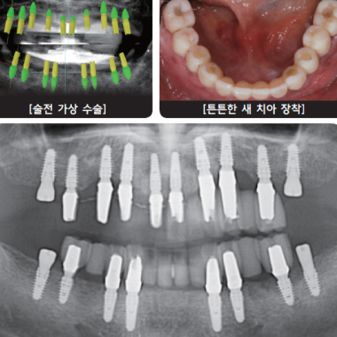 디지털 임플란트 R2 GATE 시술
